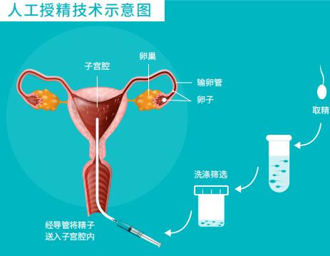 人工授精的過程與費用