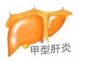 甲肝 甲肝