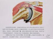 滑囊炎 滑囊炎