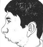顳下頜關(guān)節(jié)強直 顳下頜關(guān)節(jié)強直