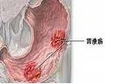 小兒消化性潰瘍