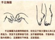 維生素D缺乏性手足抽搐癥 維生素D缺乏性手足抽搐癥