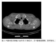 氣管、支氣管狹窄 氣管、支氣管狹窄