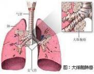 郎-奧韋綜合征 郎-奧韋綜合征