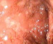 慢性潰瘍性非肉芽腫性空腸回腸炎 慢性潰瘍性非肉芽腫性空腸回腸炎