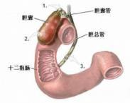 慢性膽囊炎 慢性膽囊炎