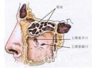 篩竇惡性腫瘤 篩竇惡性腫瘤