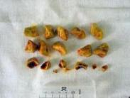 膽囊結(jié)石 膽囊結(jié)石