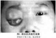 小兒橫紋肌肉瘤