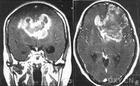小兒大腦半球膠質瘤 小兒大腦半球膠質瘤