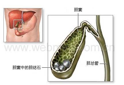 膽結(jié)石