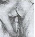 乳頭狀小汗腺腺瘤 乳頭狀小汗腺腺瘤