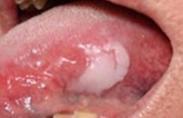 軟腭癌 軟腭癌