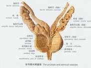 精囊囊腫 精囊囊腫