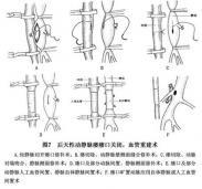 動(dòng)靜脈瘺 動(dòng)靜脈瘺