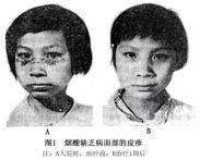 小兒煙酸缺乏病 小兒煙酸缺乏病