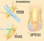 男性節(jié)育