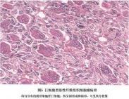 腹膜后腫瘤 腹膜后腫瘤