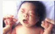 小兒唐氏綜合征 小兒唐氏綜合征