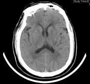 腔隙性腦梗死 腔隙性腦梗死