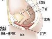 膀胱脫垂 膀胱脫垂