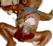 泄殖腔外翻 泄殖腔外翻