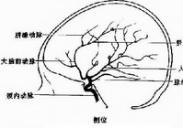 外傷后頸內(nèi)動(dòng)脈閉塞 外傷后頸內(nèi)動(dòng)脈閉塞
