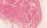 先天性腫瘤 先天性腫瘤