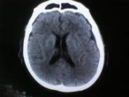 老年人腔隙性腦梗死 老年人腔隙性腦梗死