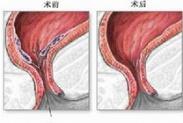 外傷性腹膜后出血或血腫 外傷性腹膜后出血或血腫