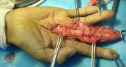 化膿性腱鞘炎 化膿性腱鞘炎