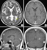 小兒顱后窩室管膜瘤