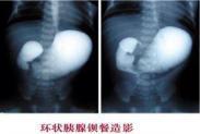 環狀胰腺 環狀胰腺