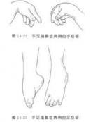 嬰兒手足搐搦癥 嬰兒手足搐搦癥