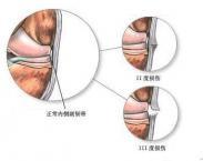 膝關(guān)節(jié)側(cè)副韌帶損傷 膝關(guān)節(jié)側(cè)副韌帶損傷