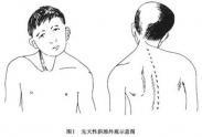 先天性斜頸