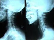 感染性肋軟骨炎