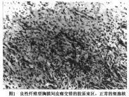 局限性胸膜間皮瘤 局限性胸膜間皮瘤