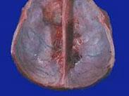 多發性腦膜瘤