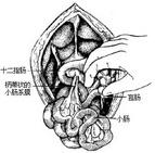 先天性腸旋轉不良 先天性腸旋轉不良