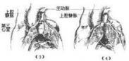 法洛氏四聯癥